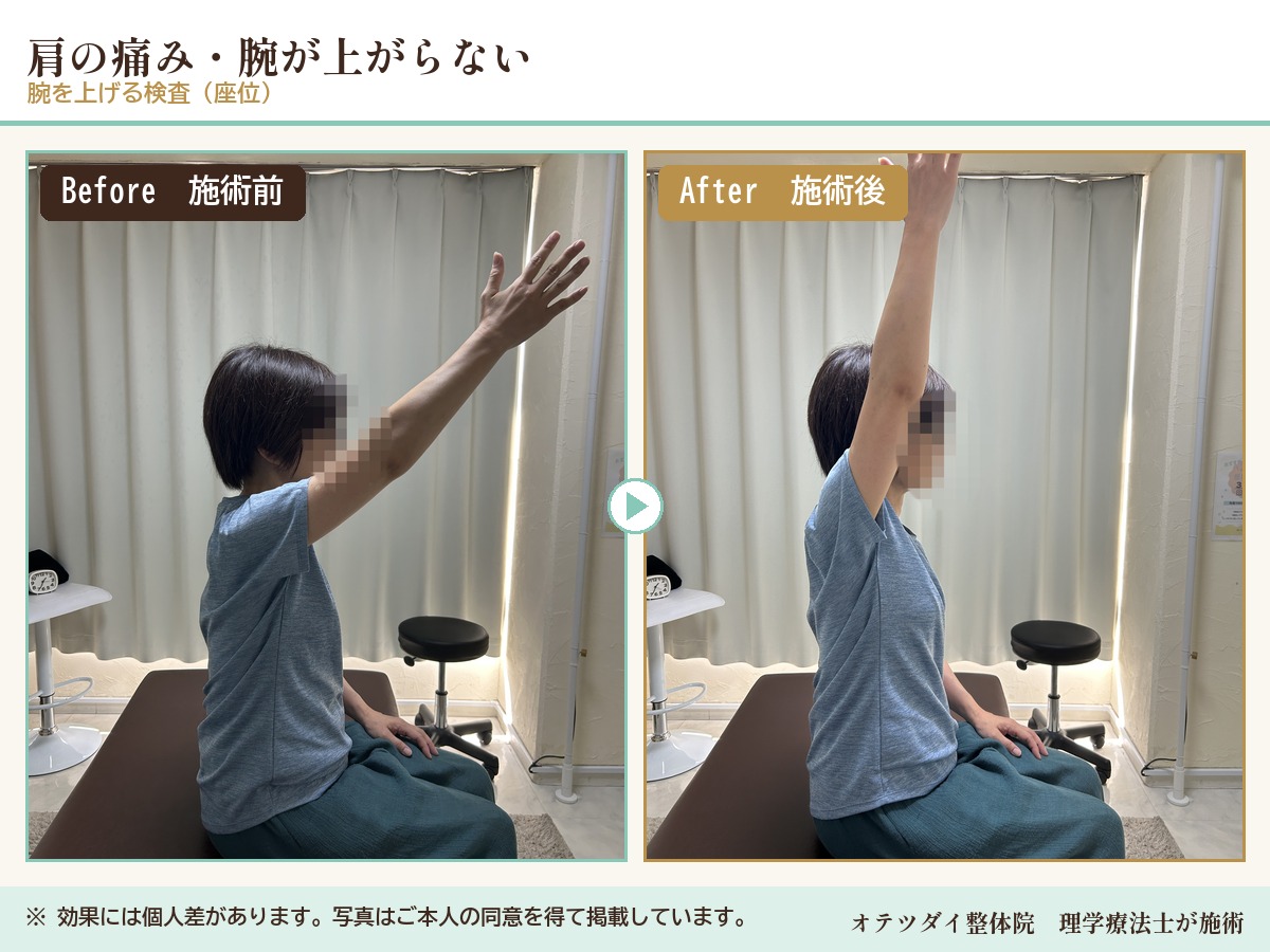 肩の痛み・腕が上がらない 施術前後の比較（腕を上げる検査）
