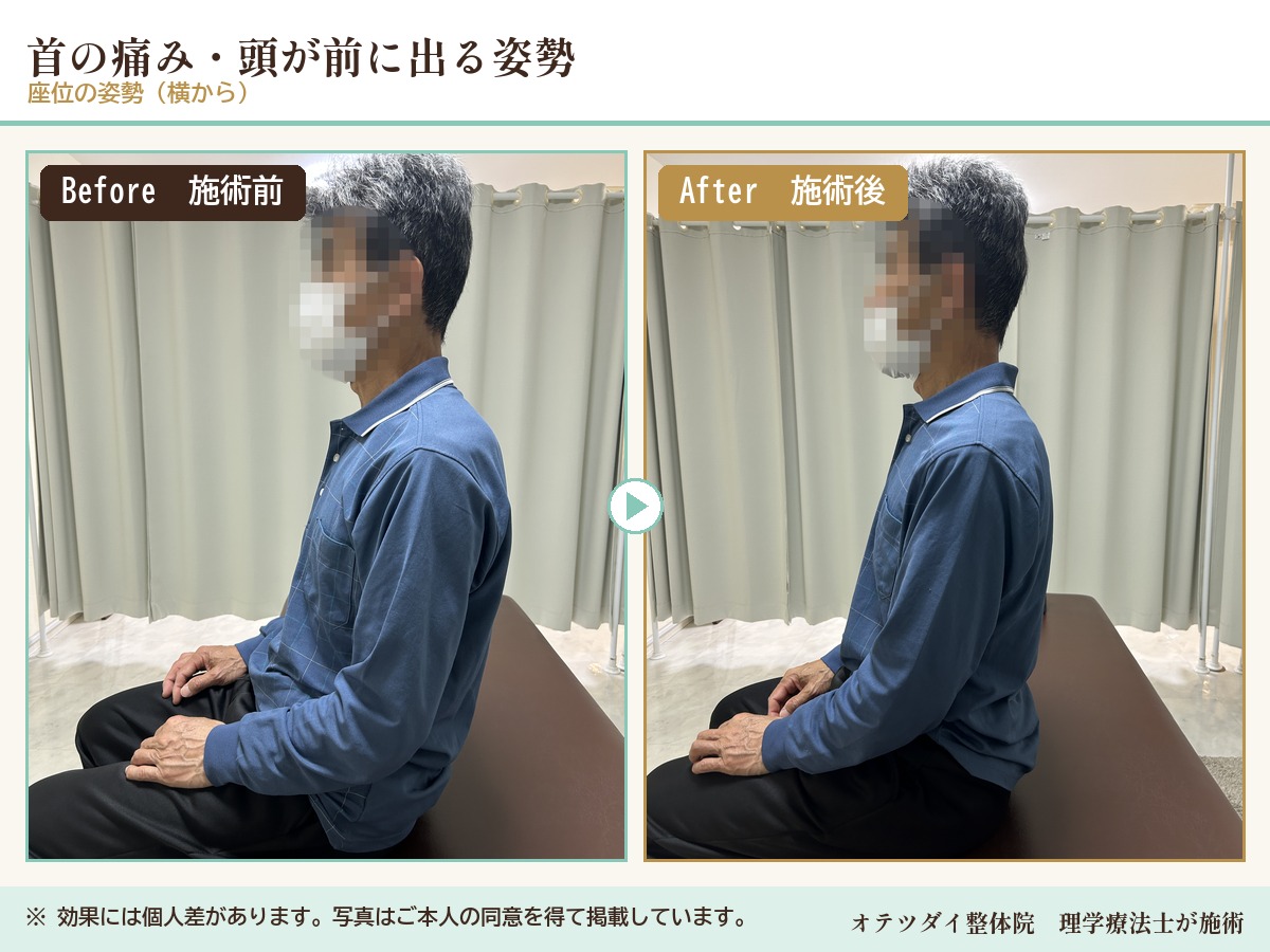 首の痛み・頭が前に出る姿勢 施術前後の比較（座位の姿勢）