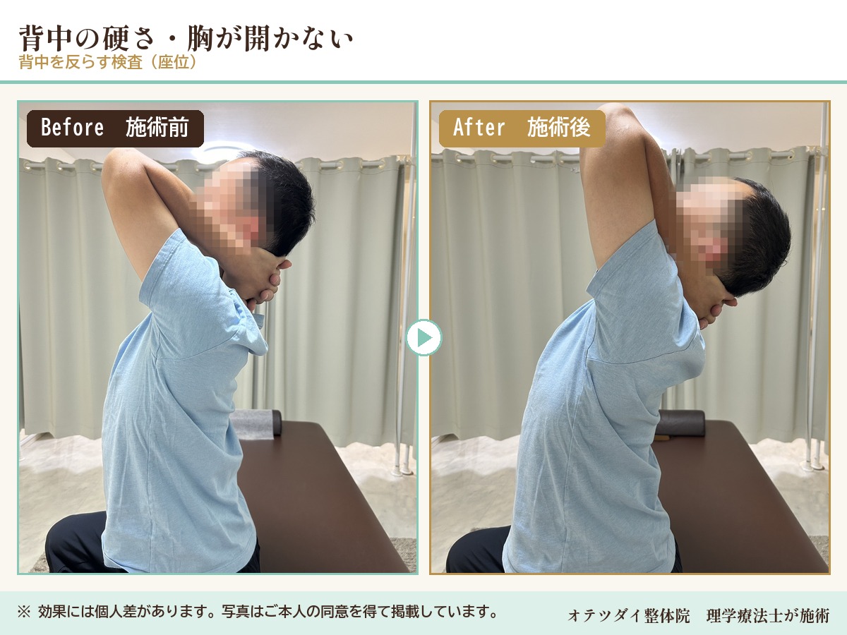 背中の硬さ・胸が開かない 施術前後の比較(背中を反らす検査)