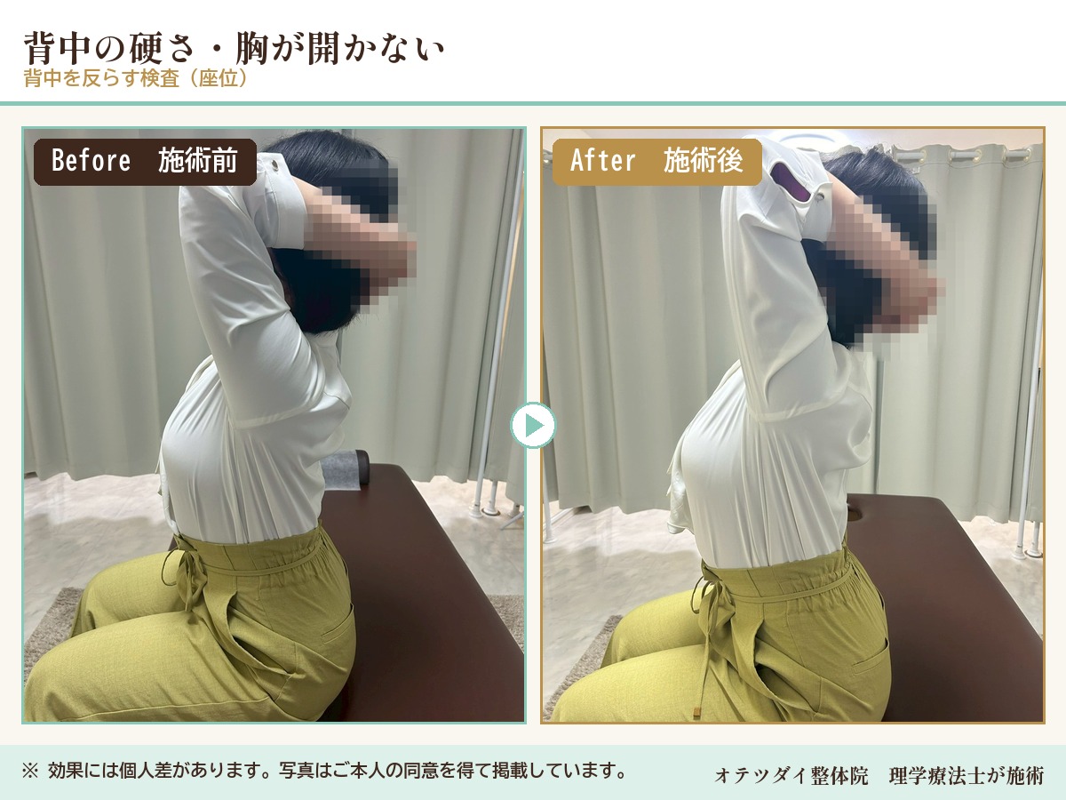 背中の硬さ・胸が開かない 施術前後の比較(背中を反らす検査)