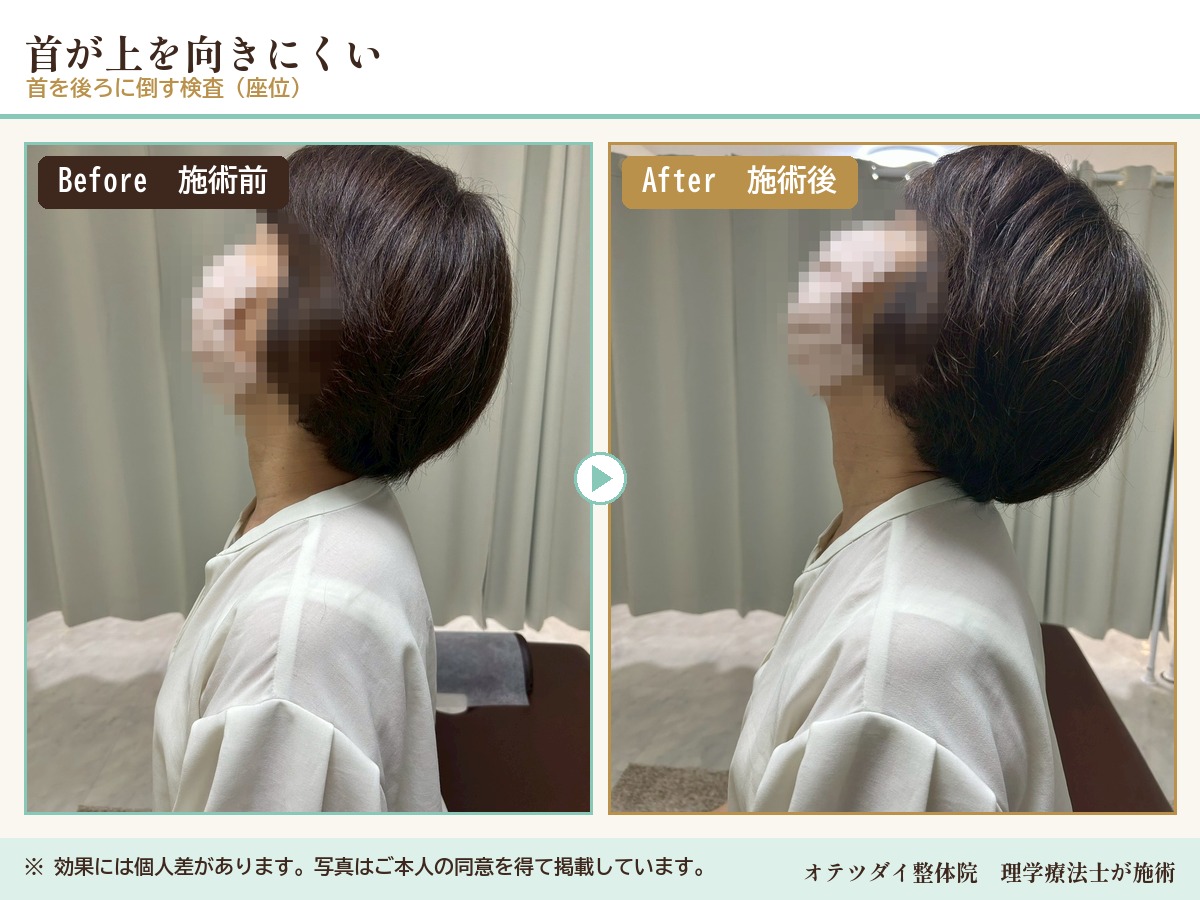 首が上を向きにくい 施術前後の比較(首を後ろに倒す検査)