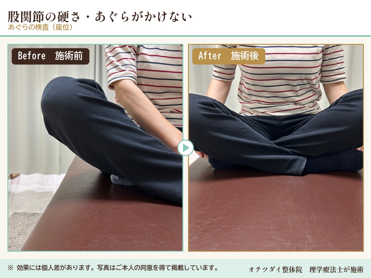 股関節の硬さ・あぐらがかけない 施術前後の比較(あぐらの検査)