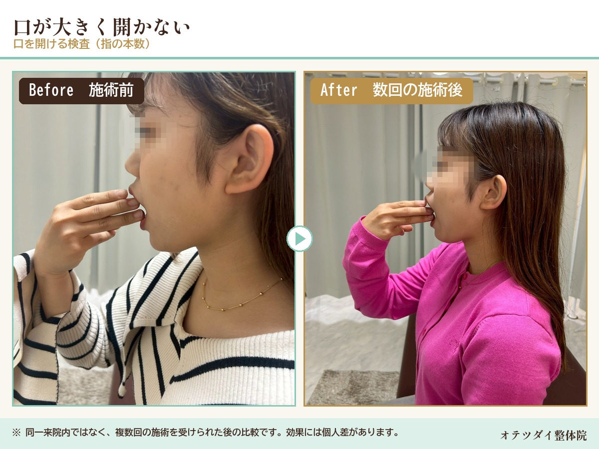口が大きく開かない 複数回の施術後の比較(口を開ける検査)