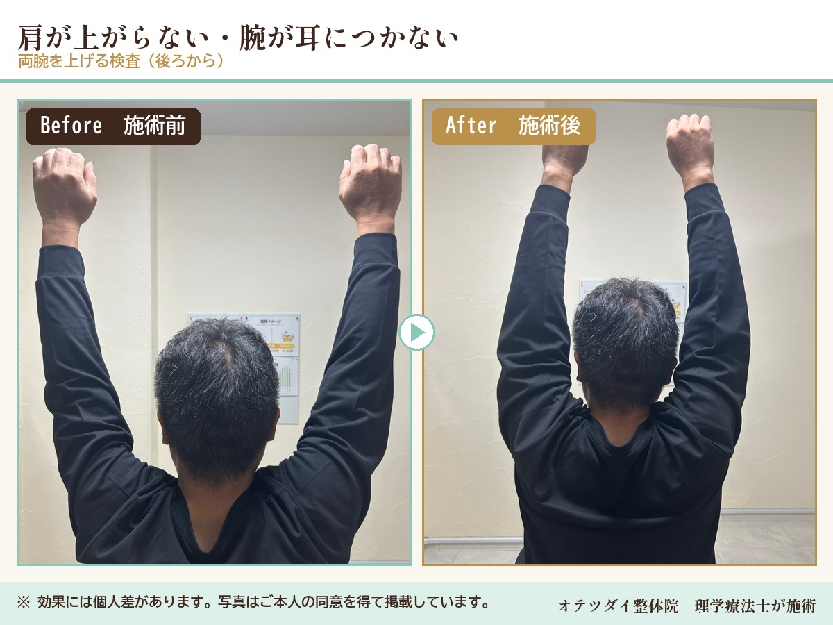 肩が上がらない・腕が耳につかない 施術前後の比較(両腕を上げる検査)