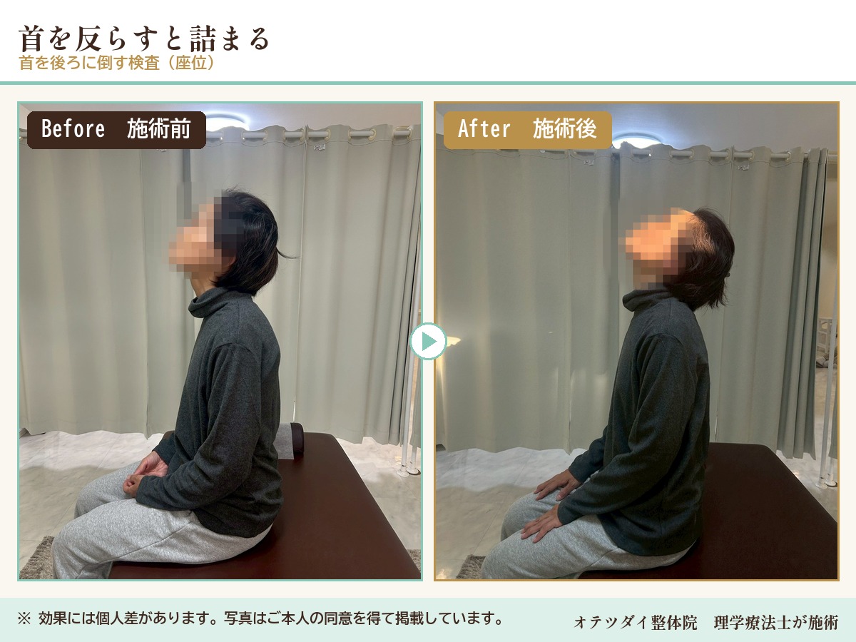 首を反らすと詰まる 施術前後の比較(首を後ろに倒す検査)