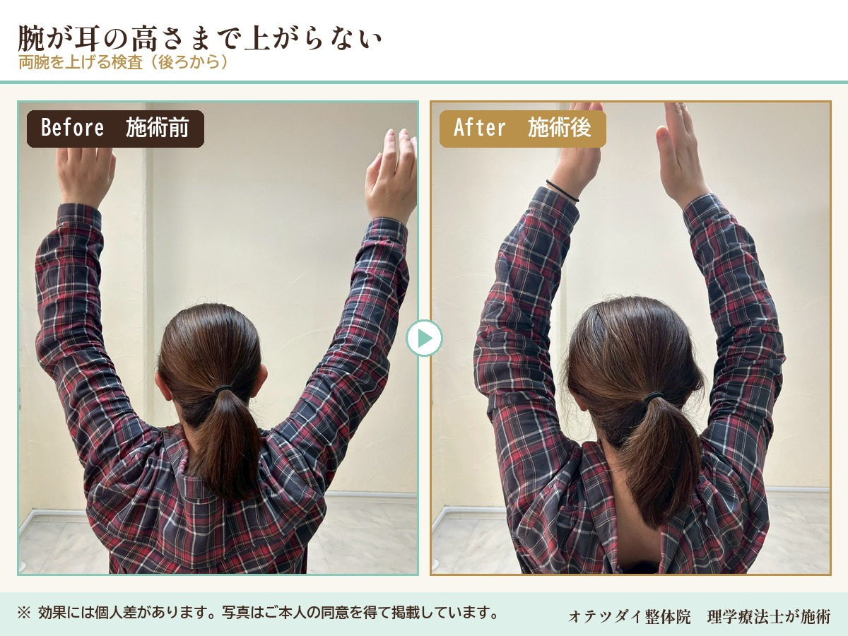 腕が耳の高さまで上がらない 施術前後の比較(両腕を上げる検査)